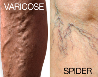 Know Who Is At Risk For Varicose Veins